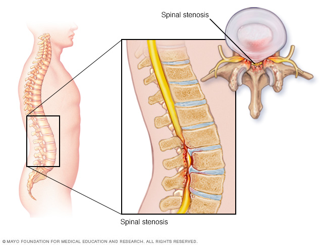 spinal stenose