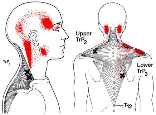 øvre trapezius triggerpunkt