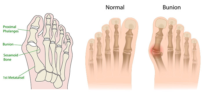 hallux valgus