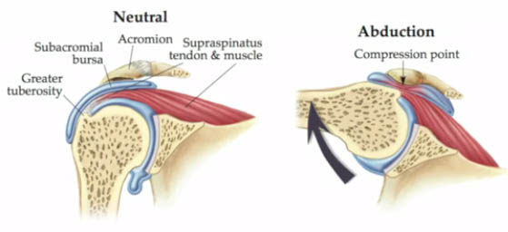 impingement syndrom - avklemming i skulderen