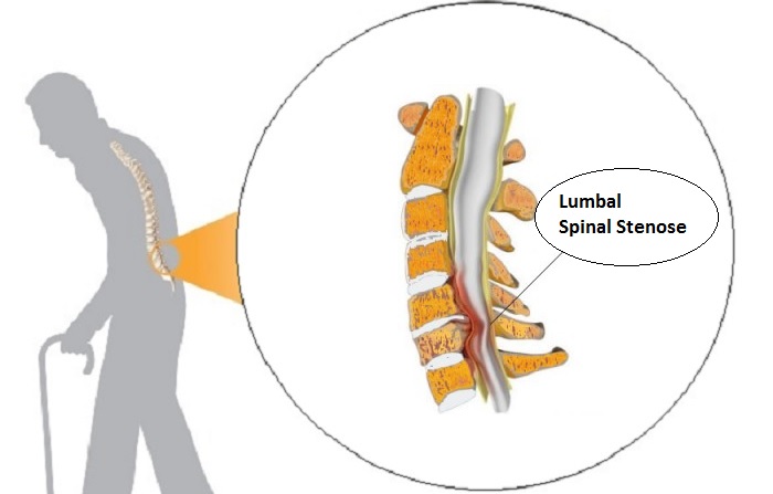spinal stenose i korsryggen
