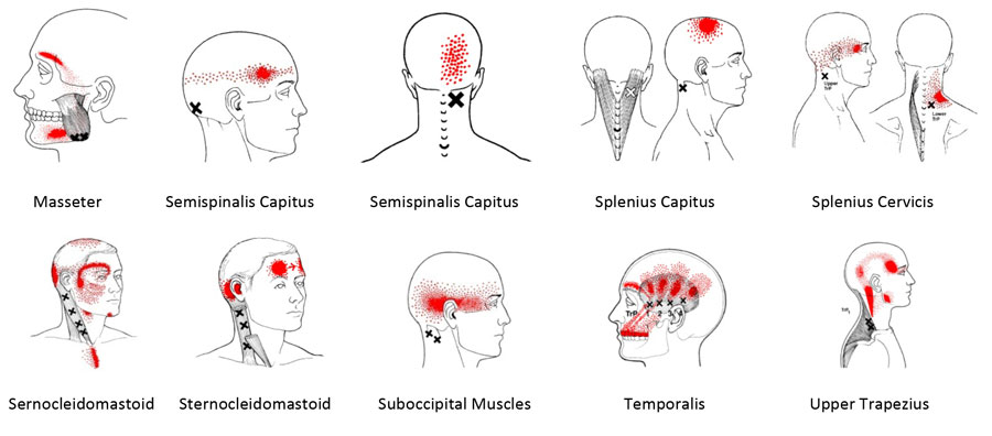 triggerpunkter og muskler som gir hodepine