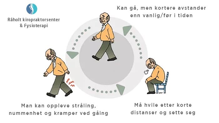 spinal stenose og problemer ved gange