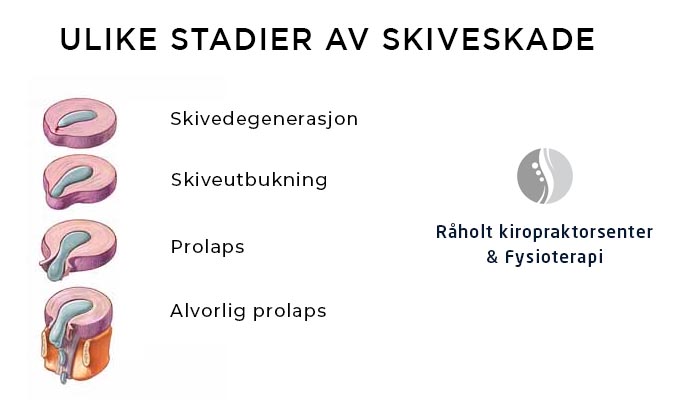 ulike stadier av skiveskade