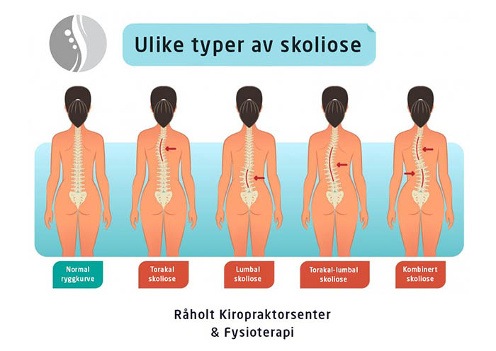 ulike typer av skoliose