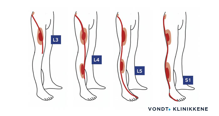 Oversiktsbilde som viser hvordan stråling i beina kan forekomme ved prolaps eller spinal stenose.