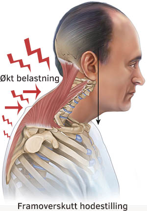 Svimmelhet stiv nakke og synsproblemer